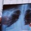 В Константиновке зафиксировано 120 случаев заболеваний пневмонией с начала года